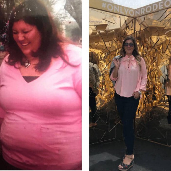 Vanessa - before and after Duodenal Switch
