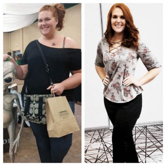 Heidi - before and after Sleeve Gastrectomy
