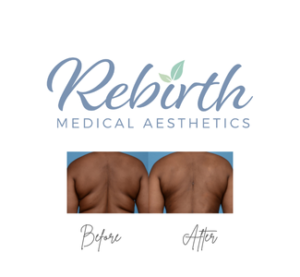 Bodytite - Upper Back w/ Affirm Financing