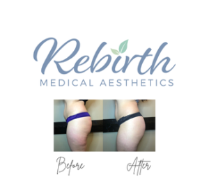 Bodytite - Thighs w/ Affirm Financing