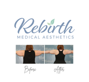 Bodytite - Arms w/ Affirm Financing