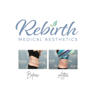 Bodytite - Flanks w/ Affirm Financing